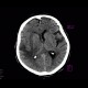 Stroke, cerebral ischemia, acute stage, MCA, medial cerebral artery: CT - Computed tomography